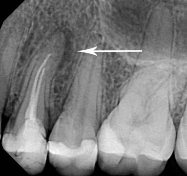 Tooth Abscess | OraWellness