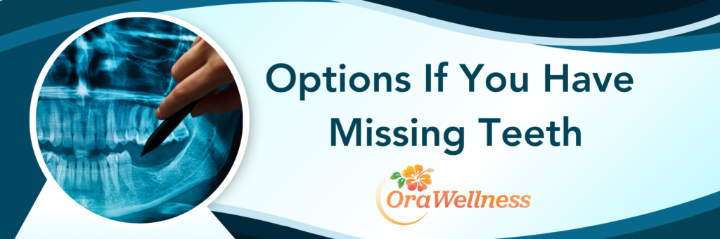 Options If You Have Missing Teeth