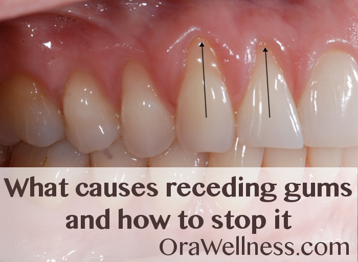 how can i fix my receding gums at home