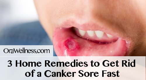 3 Home Remedies to Get Rid of a Canker Sore Fast | OraWellness