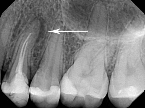 tooth abscess xray
