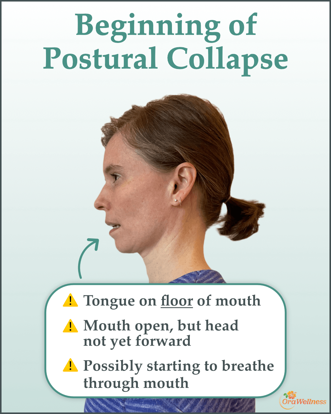 Beginning of Postural Collapse / Tongue on floor of mouth / Mouth open, but head not yet forward / Possibly starting to breathe through mouth