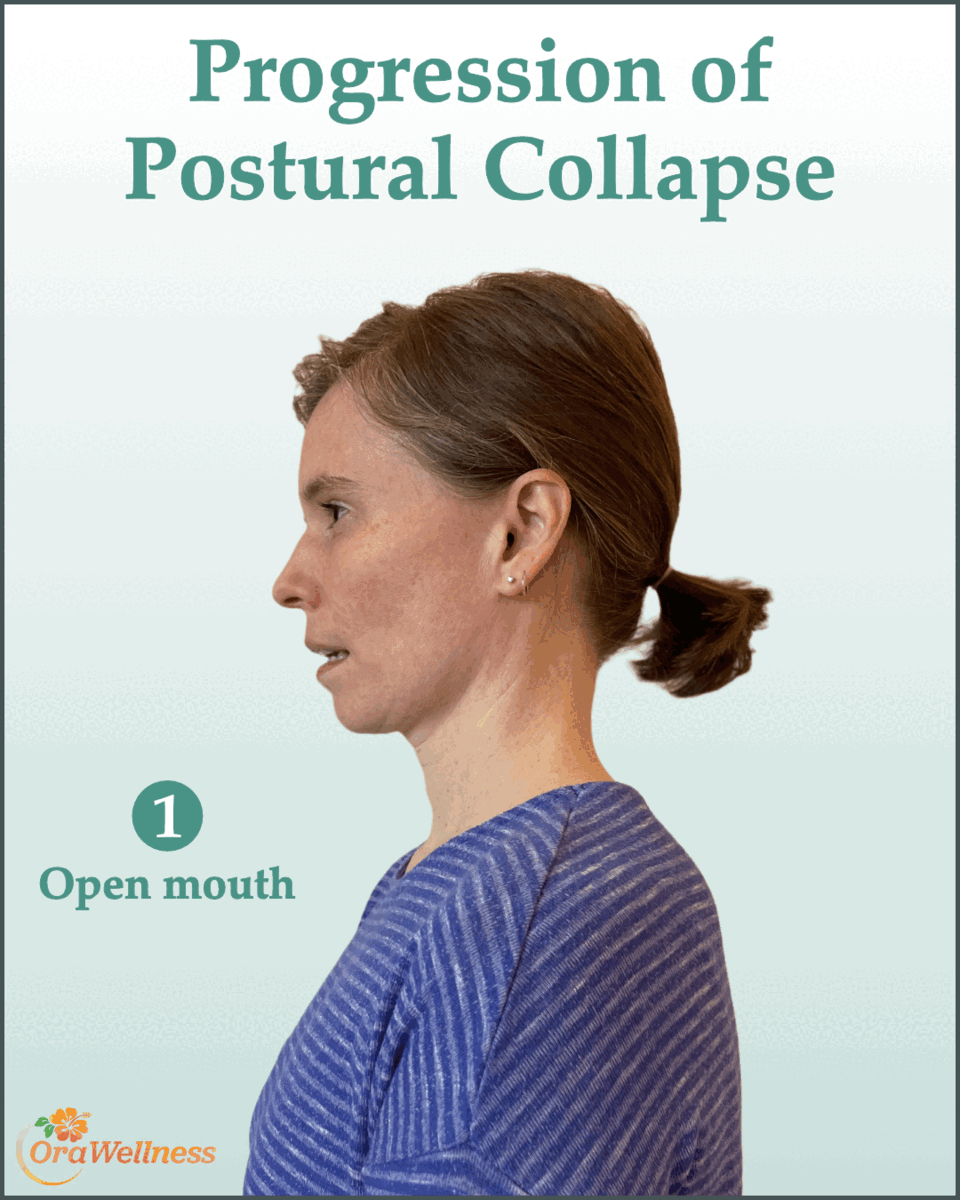 Progression of Posture Collapse / 1. Open mouth / 2. Head tilts back (pain starts) / 3. Neck & jaw push forward / 4. Major collapse ("tech neck")